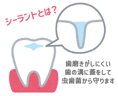 シーラントとは？歯磨きしにくい虫歯の溝に蓋をして虫歯菌から守ります